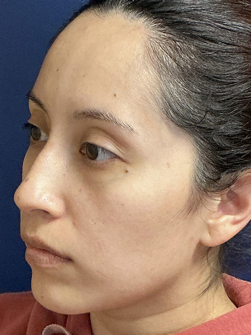 Feminizing Surgery Before & After Gallery - Patient 182872 - Image 7