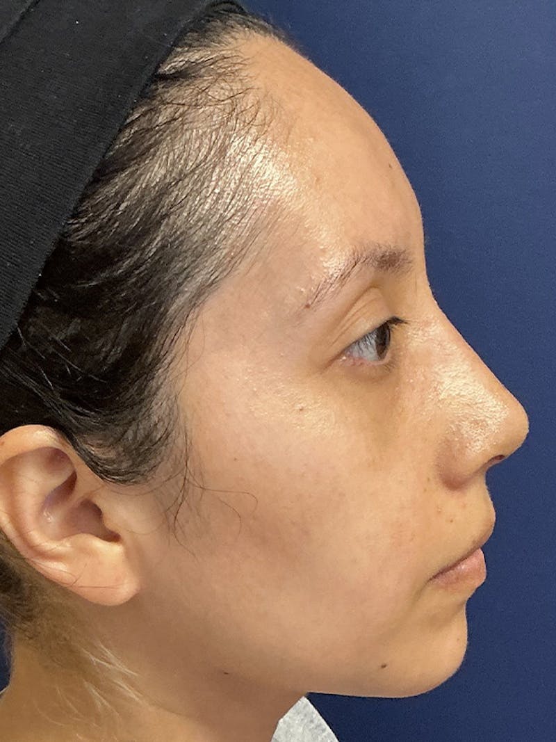 Feminizing Surgery Before & After Gallery - Patient 182872 - Image 6