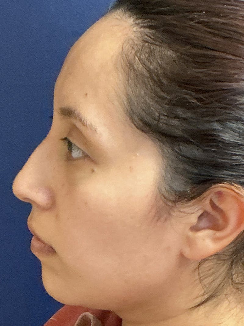 Feminizing Surgery Before & After Gallery - Patient 182872 - Image 9