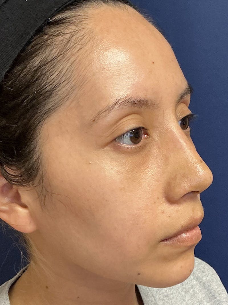Feminizing Surgery Before & After Gallery - Patient 182872 - Image 4