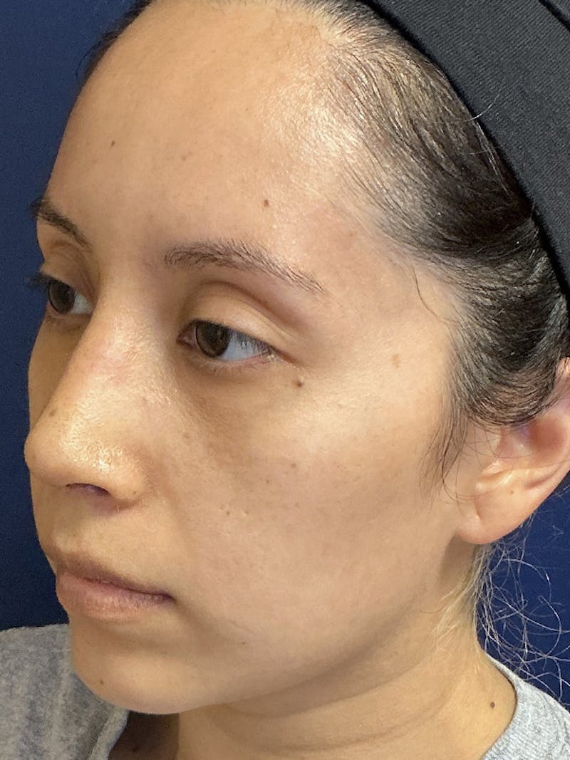 Feminizing Surgery Before & After Gallery - Patient 182872 - Image 8