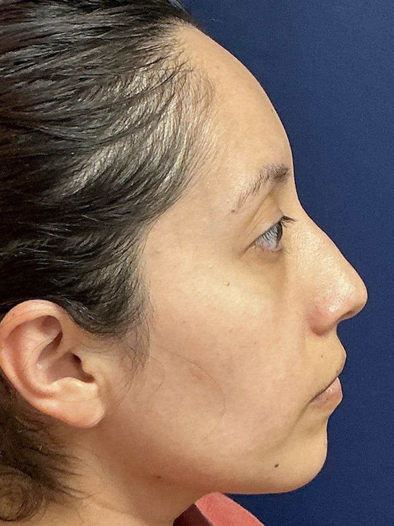 Feminizing Surgery Before & After Gallery - Patient 182872 - Image 5