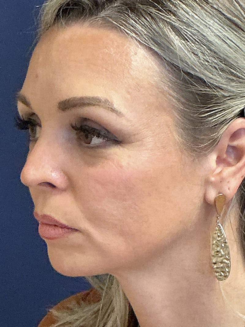 Facelift Before & After Gallery - Patient 410066 - Image 7