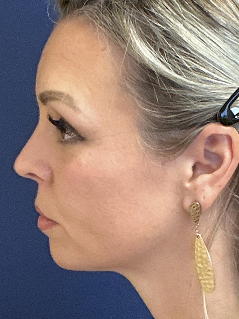 Facelift Before & After Gallery - Patient 410066 - Image 9