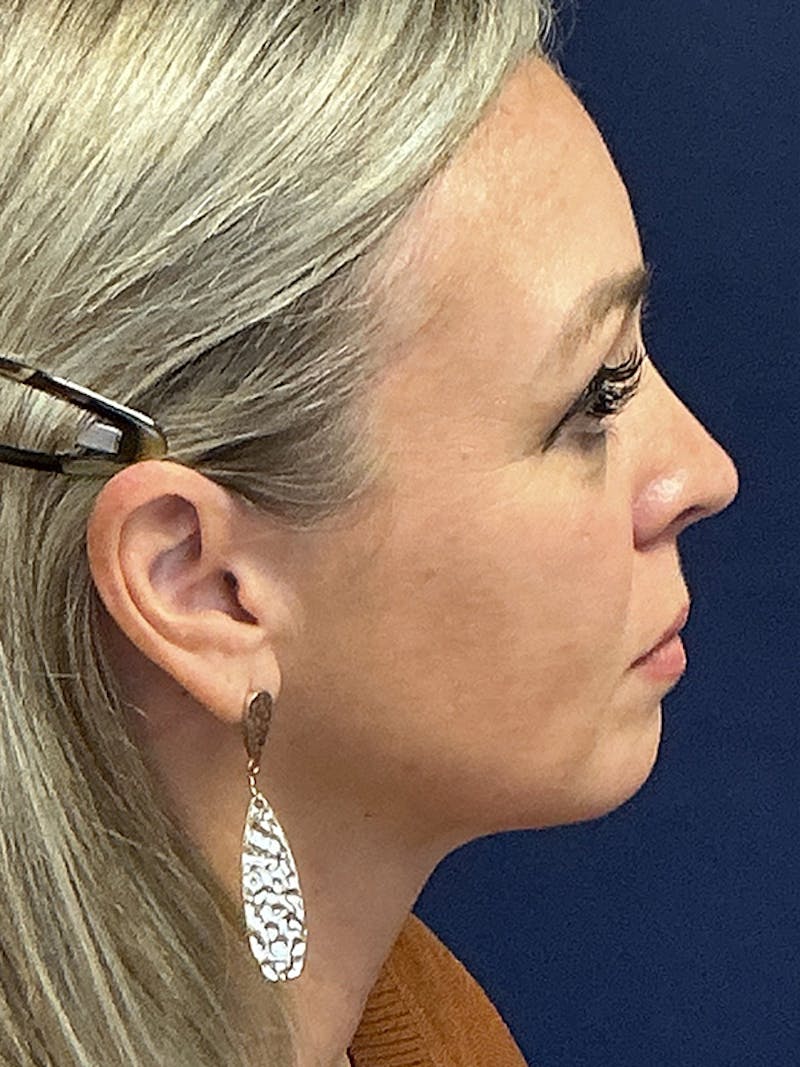 Facelift Before & After Gallery - Patient 410066 - Image 5