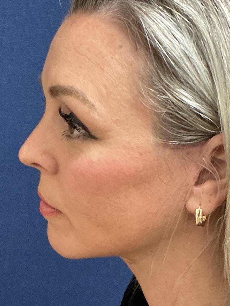 Facelift Before & After Gallery - Patient 410066 - Image 10