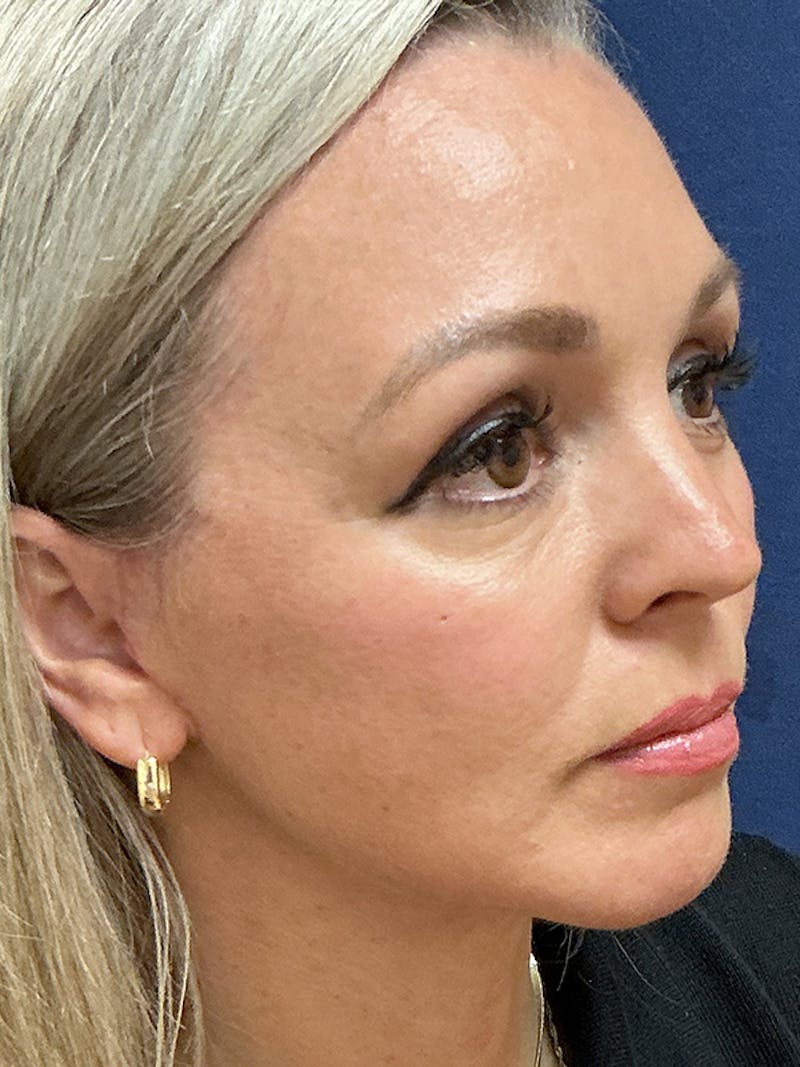 Facelift Before & After Gallery - Patient 410066 - Image 4