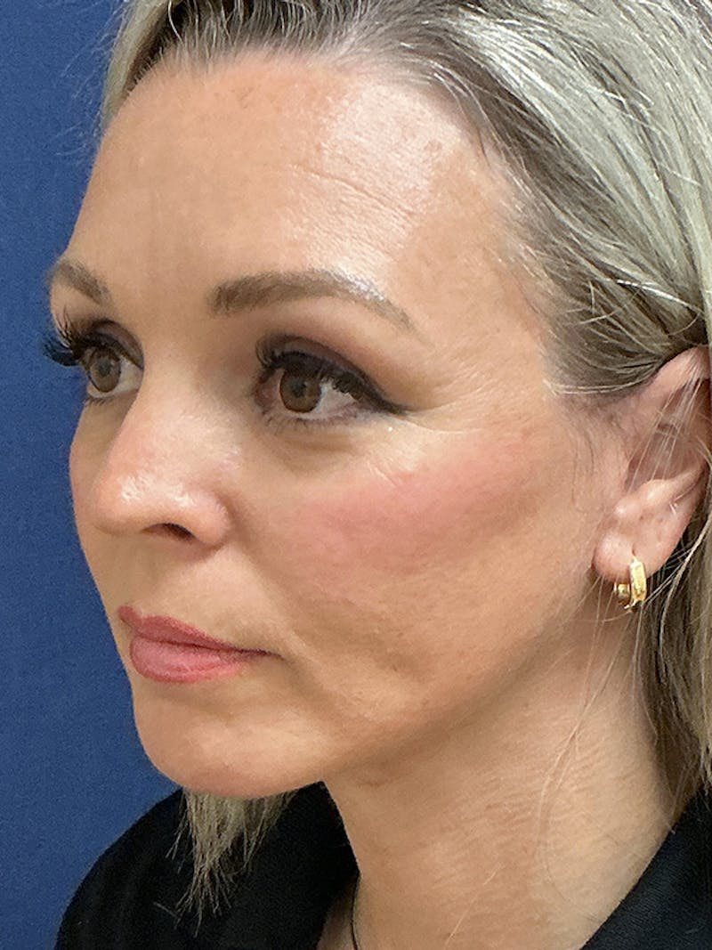 Facelift Before & After Gallery - Patient 410066 - Image 8