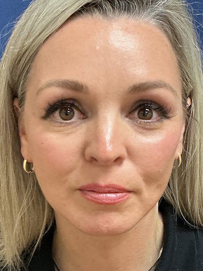 Facelift Before & After Gallery - Patient 410066 - Image 2