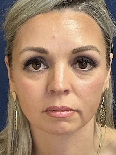 Facelift Before & After Gallery - Patient 410066 - Image 1