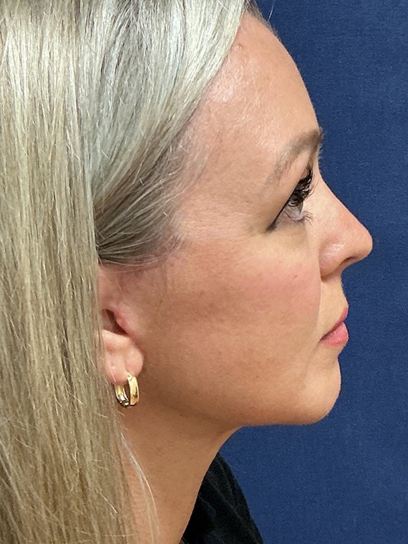 Facelift Before & After Gallery - Patient 410066 - Image 6