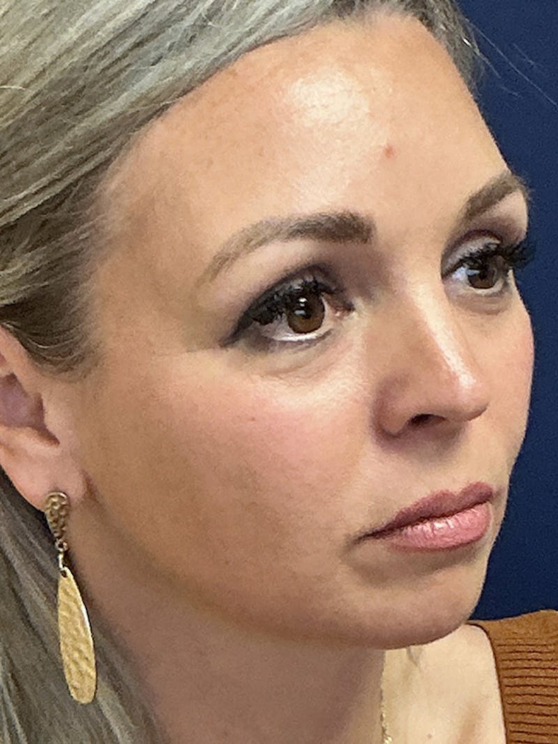 Facelift Before & After Gallery - Patient 410066 - Image 3