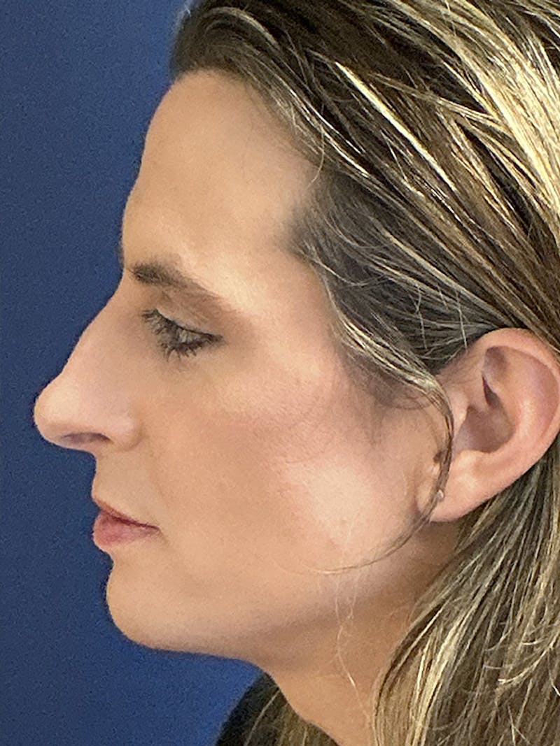 Rhinoplasty Before & After Gallery - Patient 230224 - Image 5