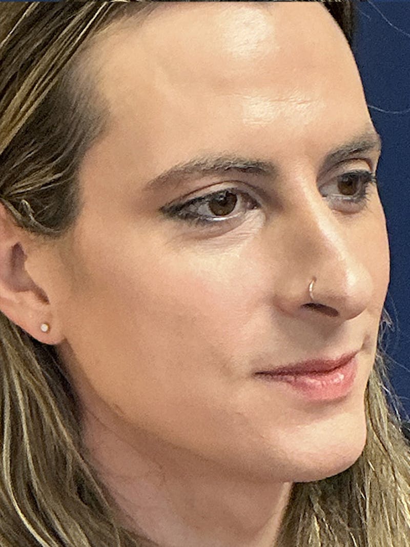Rhinoplasty Before & After Gallery - Patient 230224 - Image 3