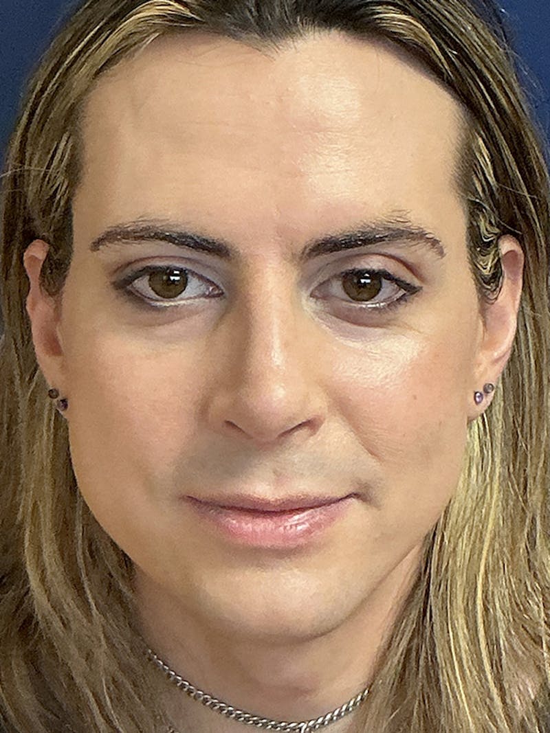 Rhinoplasty Before & After Gallery - Patient 230224 - Image 2