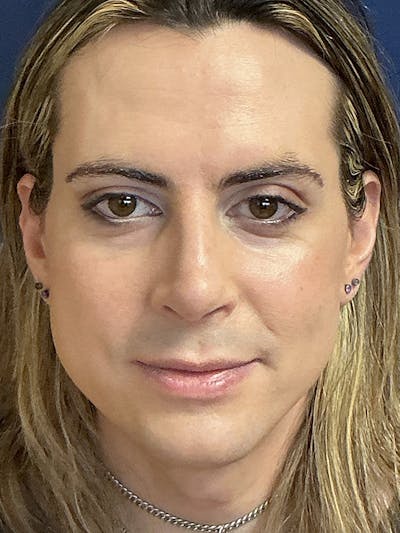 Rhinoplasty Before & After Gallery - Patient 230224 - Image 2