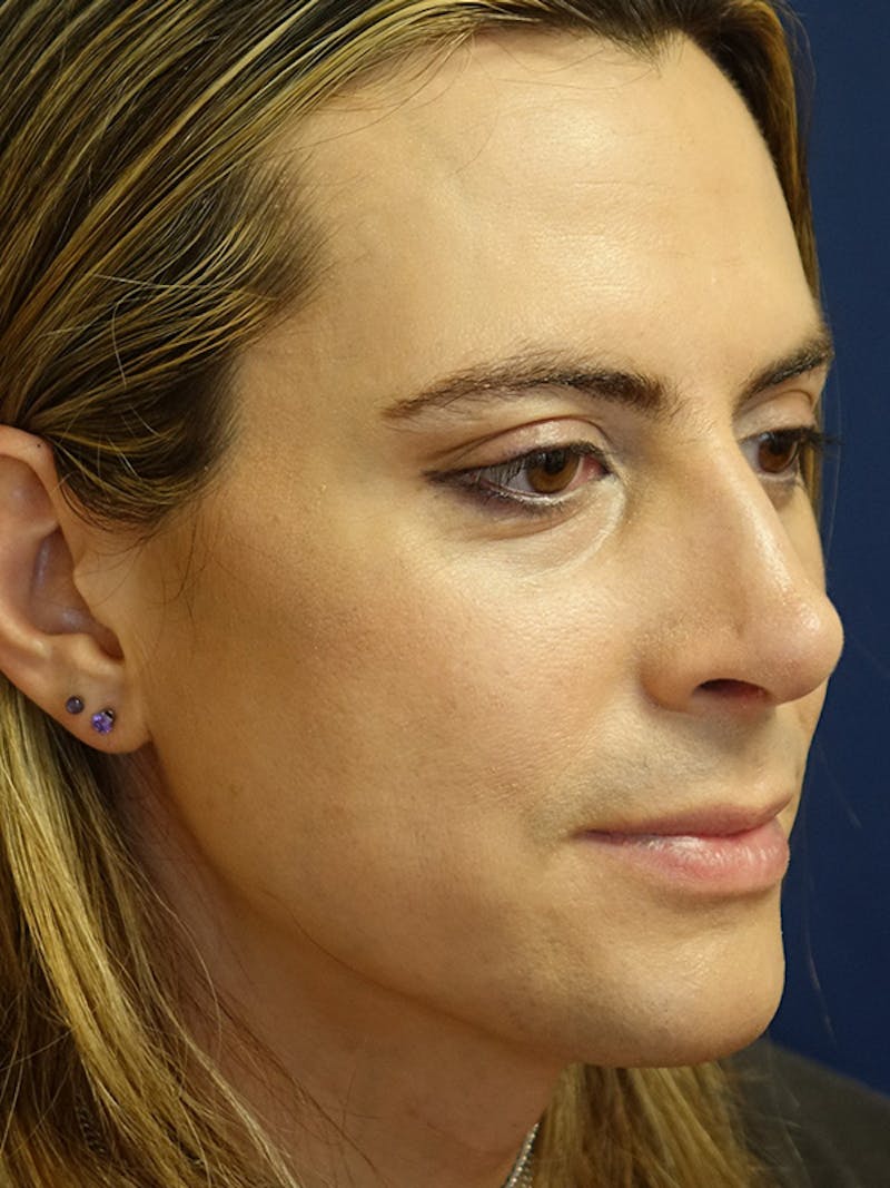 Rhinoplasty Before & After Gallery - Patient 230224 - Image 4