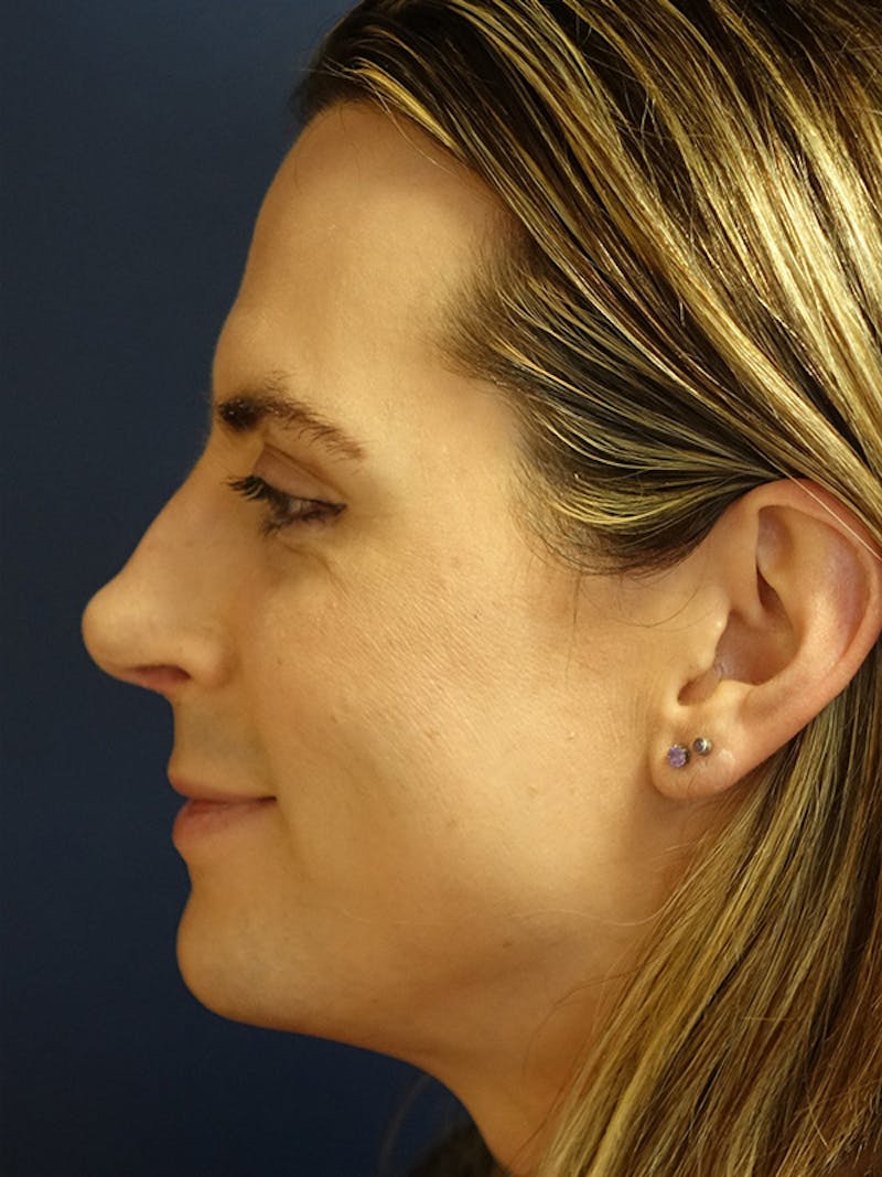 Rhinoplasty Before & After Gallery - Patient 230224 - Image 6