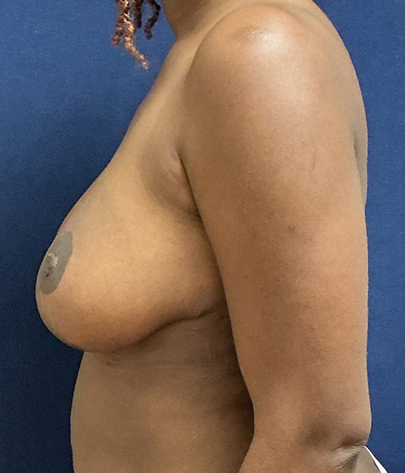 Breast Lift Before & After Gallery - Patient 572165 - Image 6