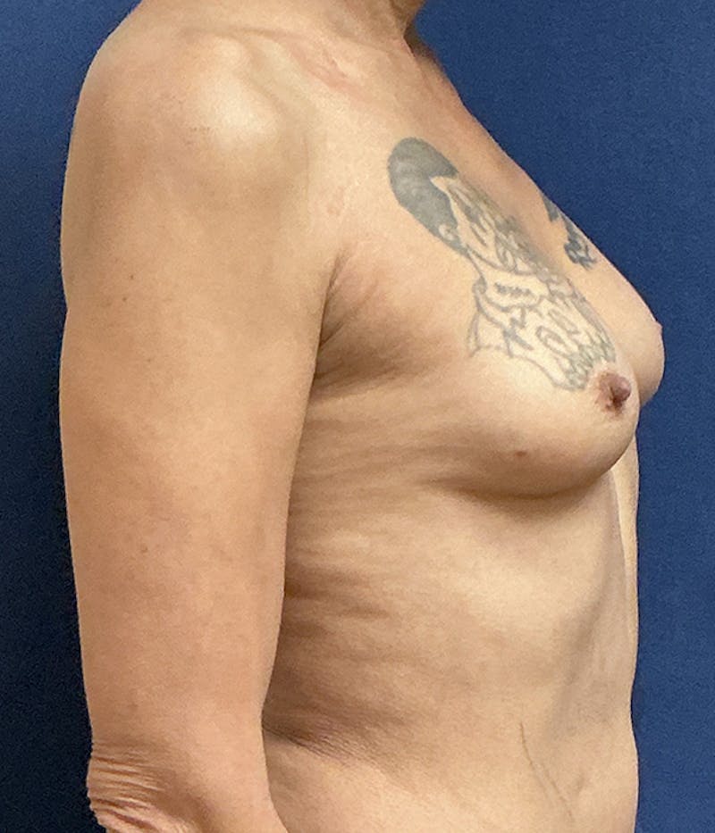 Breast Augmentation Before & After Gallery - Patient 154949 - Image 5