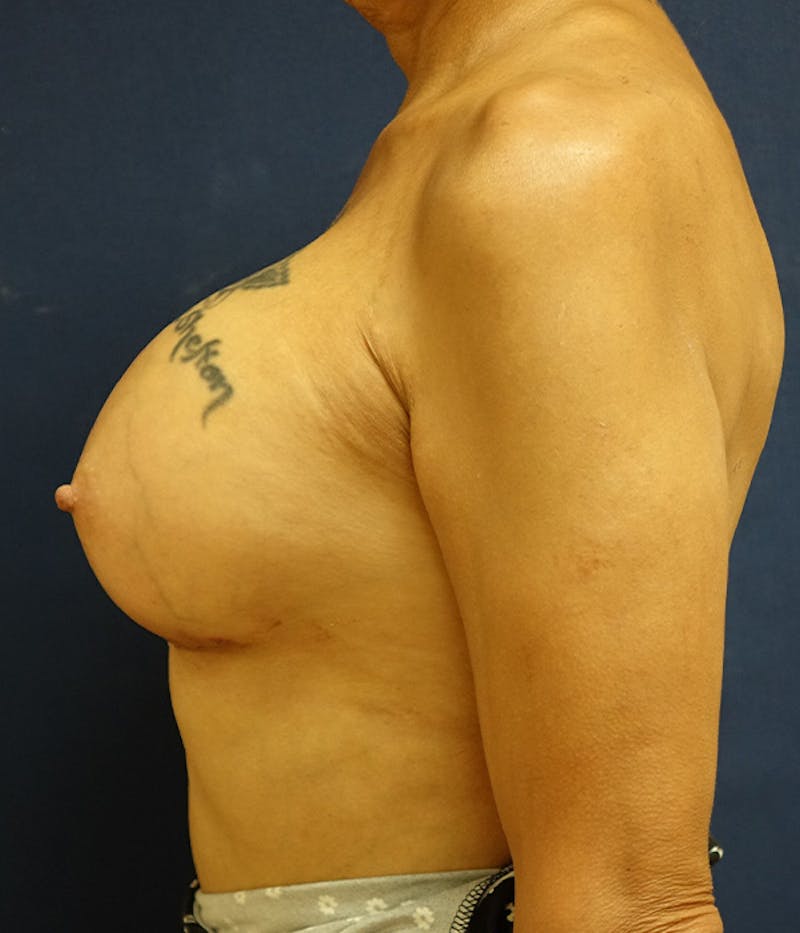 Breast Augmentation Before & After Gallery - Patient 154949 - Image 10