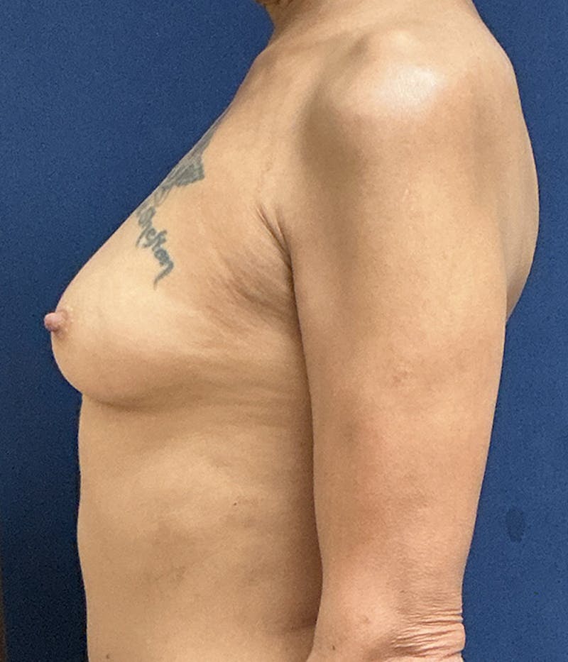 Breast Augmentation Before & After Gallery - Patient 154949 - Image 9