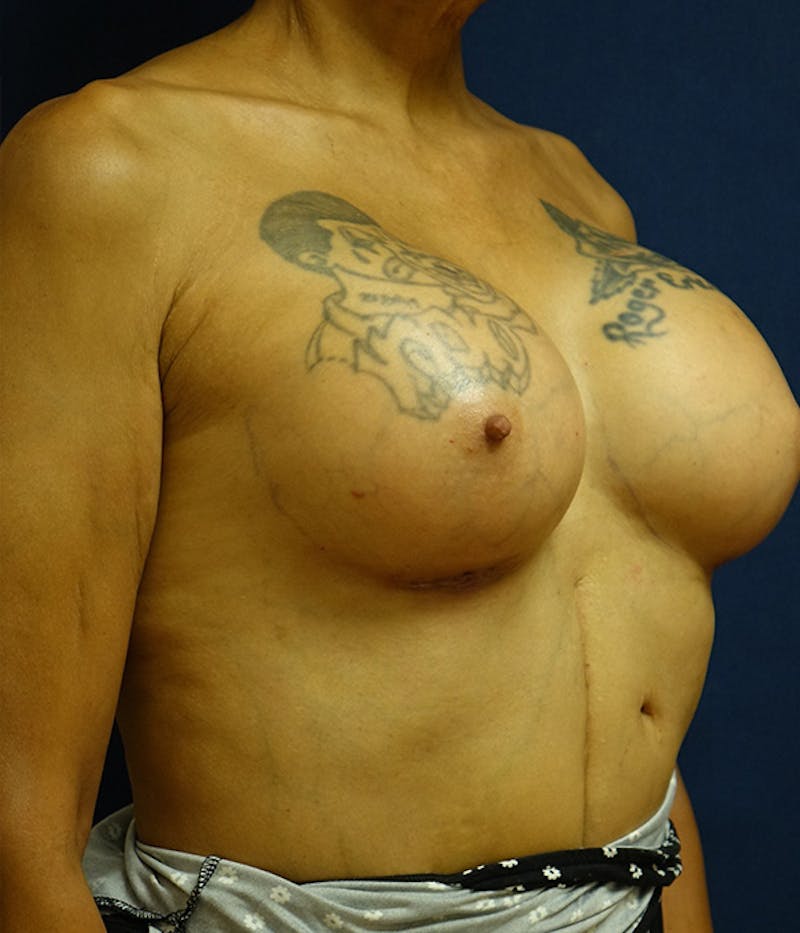 Breast Augmentation Before & After Gallery - Patient 154949 - Image 4