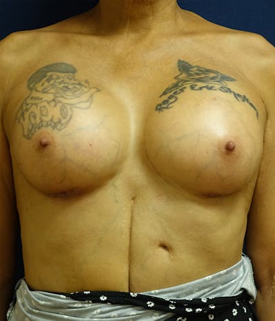 Breast Augmentation Before & After Gallery - Patient 154949 - Image 2