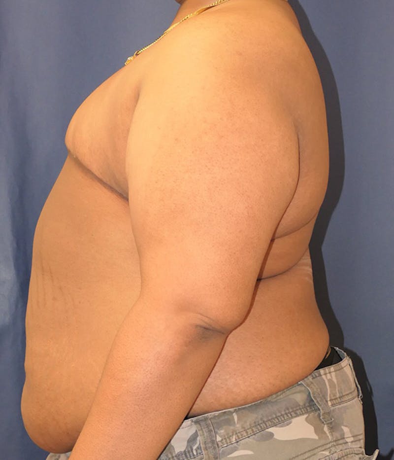 Masculinizing Surgery Before & After Gallery - Patient 267520 - Image 4