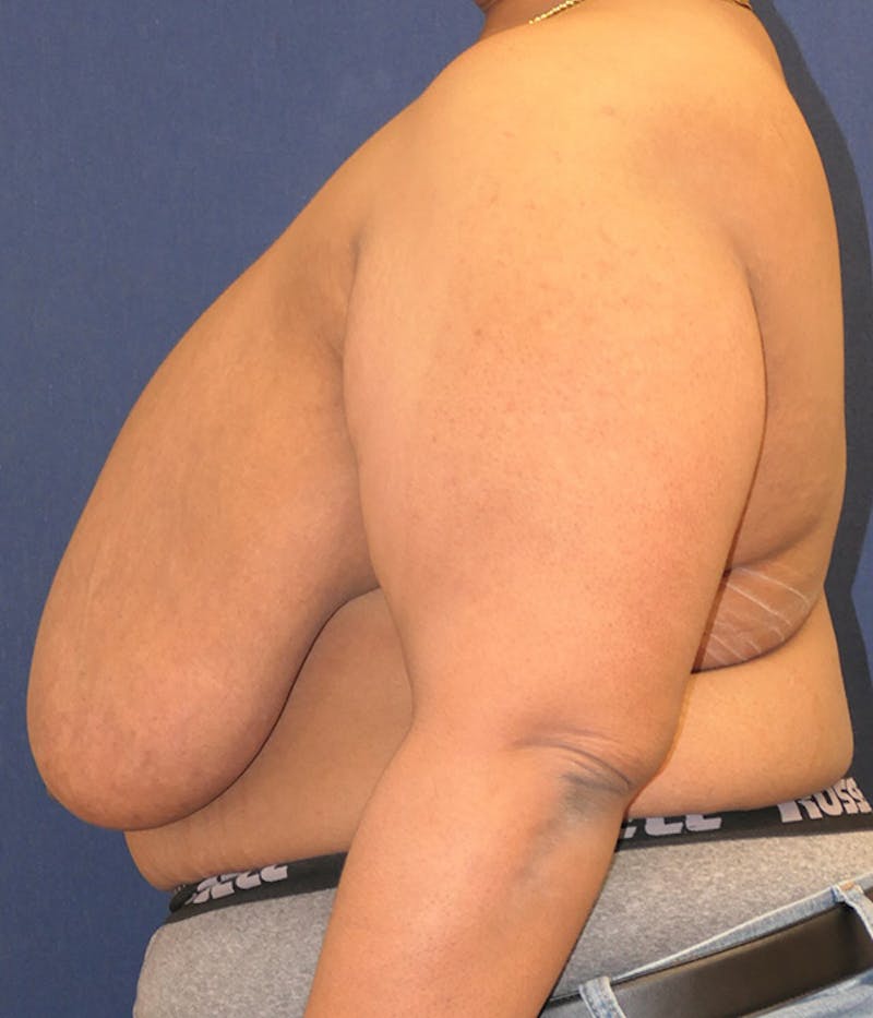 Masculinizing Surgery Before & After Gallery - Patient 267520 - Image 3