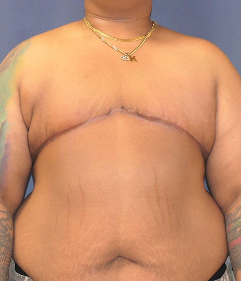 Masculinizing Surgery Before & After Gallery - Patient 267520 - Image 2