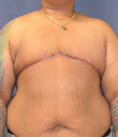 Masculinizing Surgery Before & After Gallery - Patient 267520 - Image 2