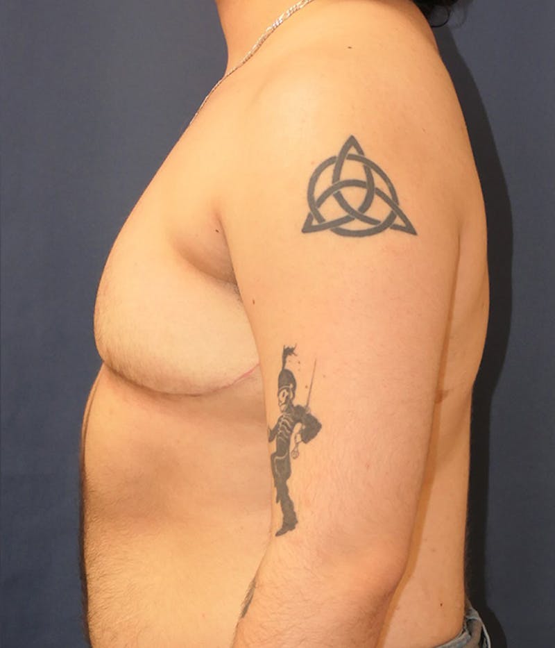 Masculinizing Surgery Before & After Gallery - Patient 166208 - Image 6