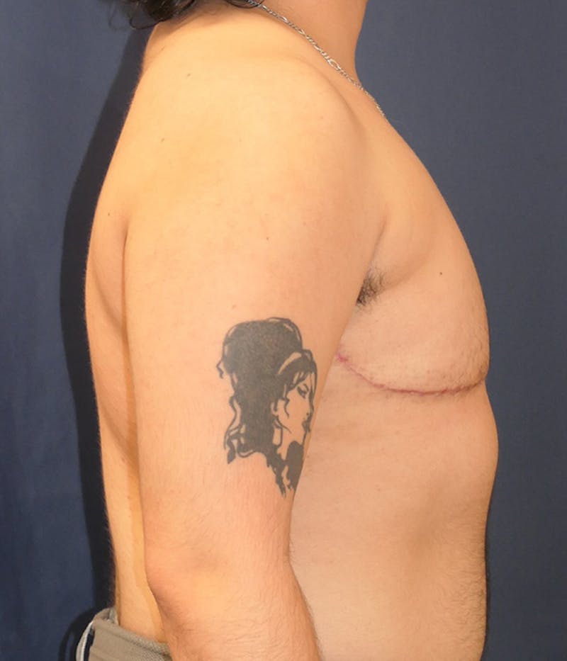 Masculinizing Surgery Before & After Gallery - Patient 166208 - Image 4