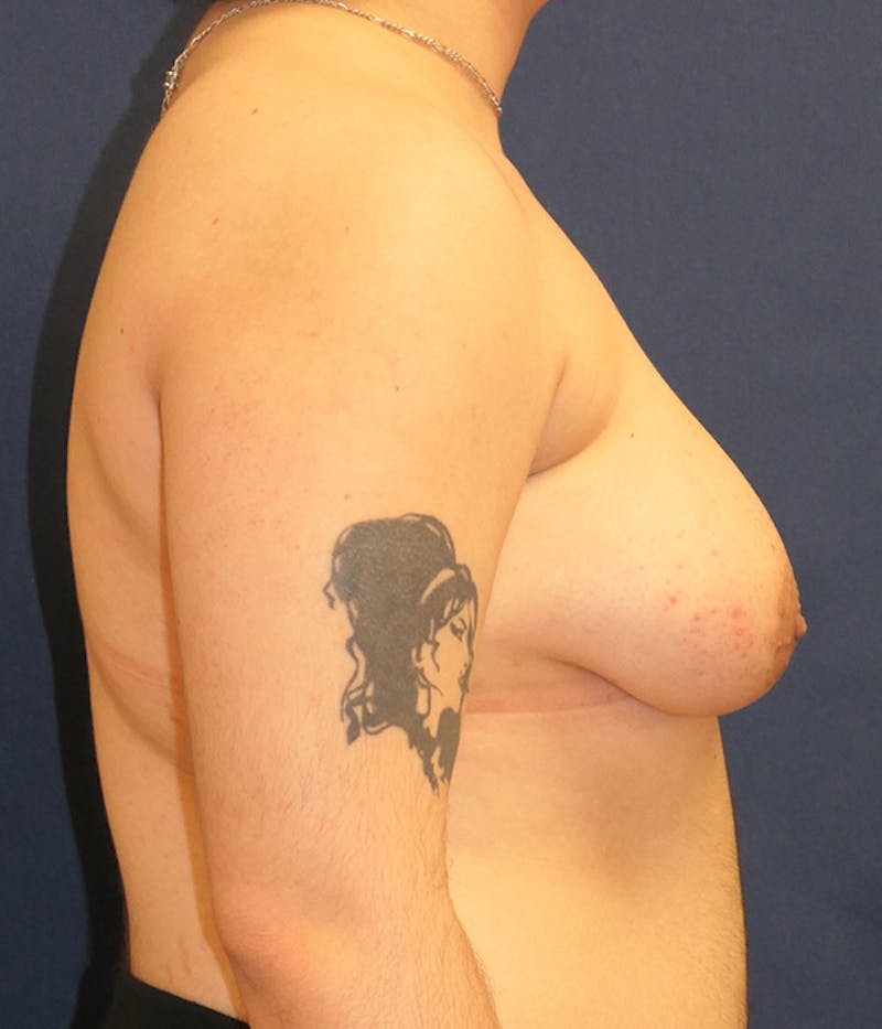 Masculinizing Surgery Before & After Gallery - Patient 166208 - Image 3