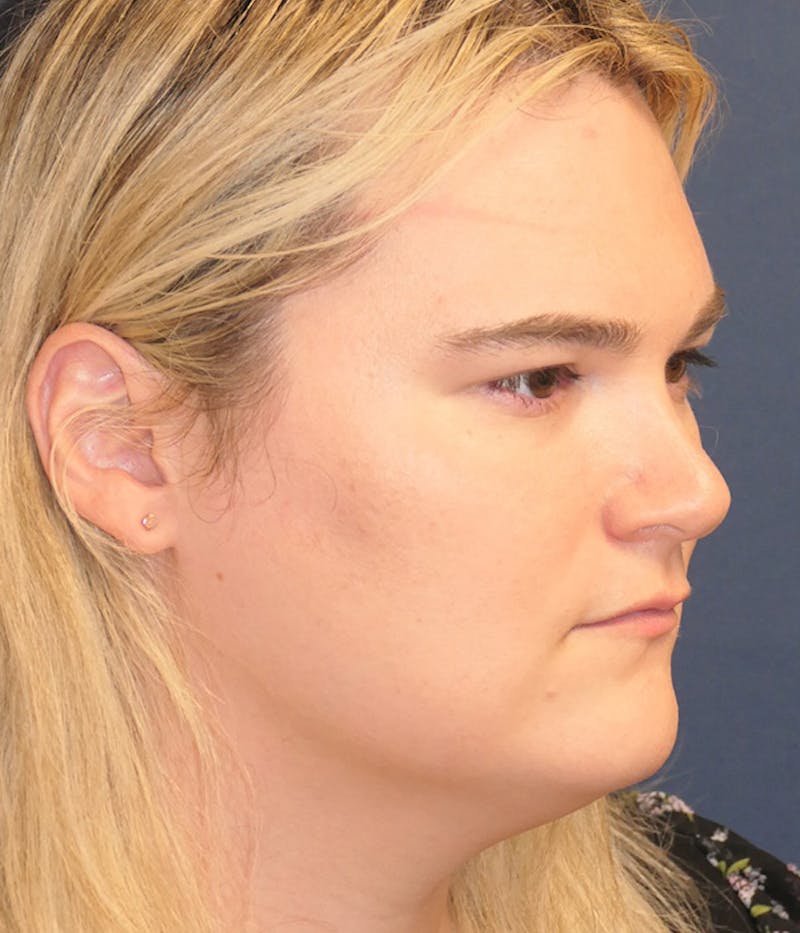 Feminizing Surgery Before & After Gallery - Patient 414617 - Image 3