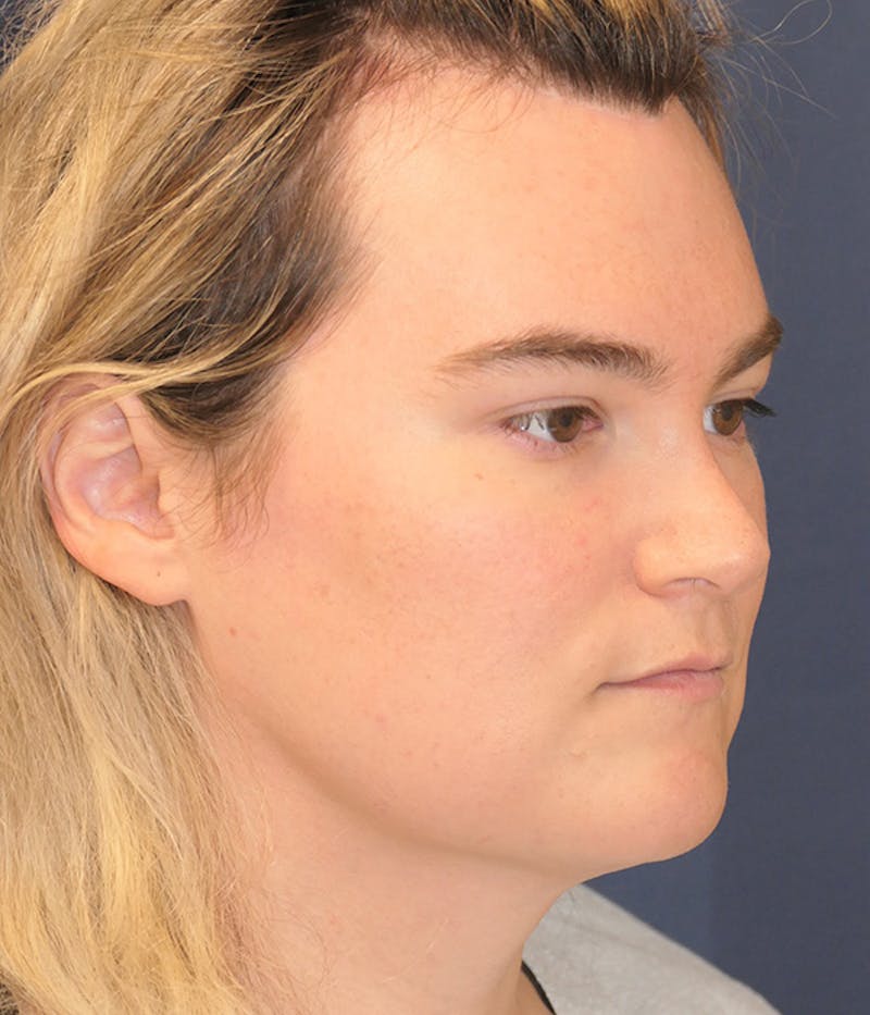 Feminizing Surgery Before & After Gallery - Patient 414617 - Image 4