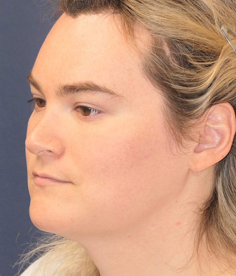 Feminizing Surgery Before & After Gallery - Patient 414617 - Image 8