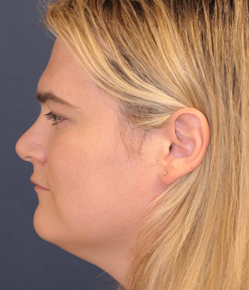 Feminizing Surgery Before & After Gallery - Patient 414617 - Image 9