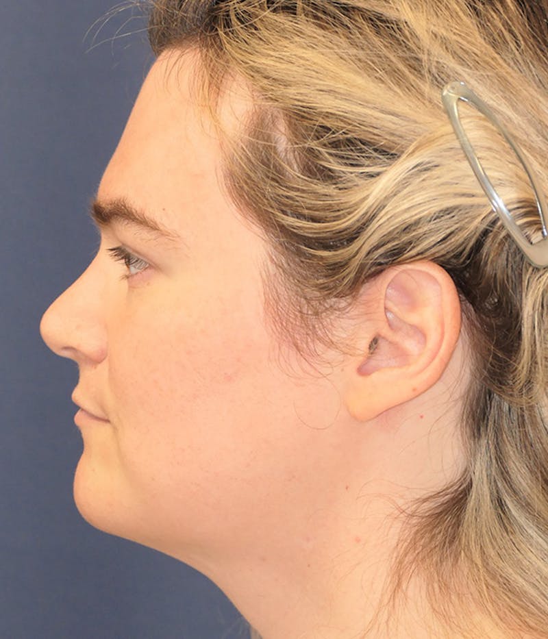 Feminizing Surgery Before & After Gallery - Patient 414617 - Image 10