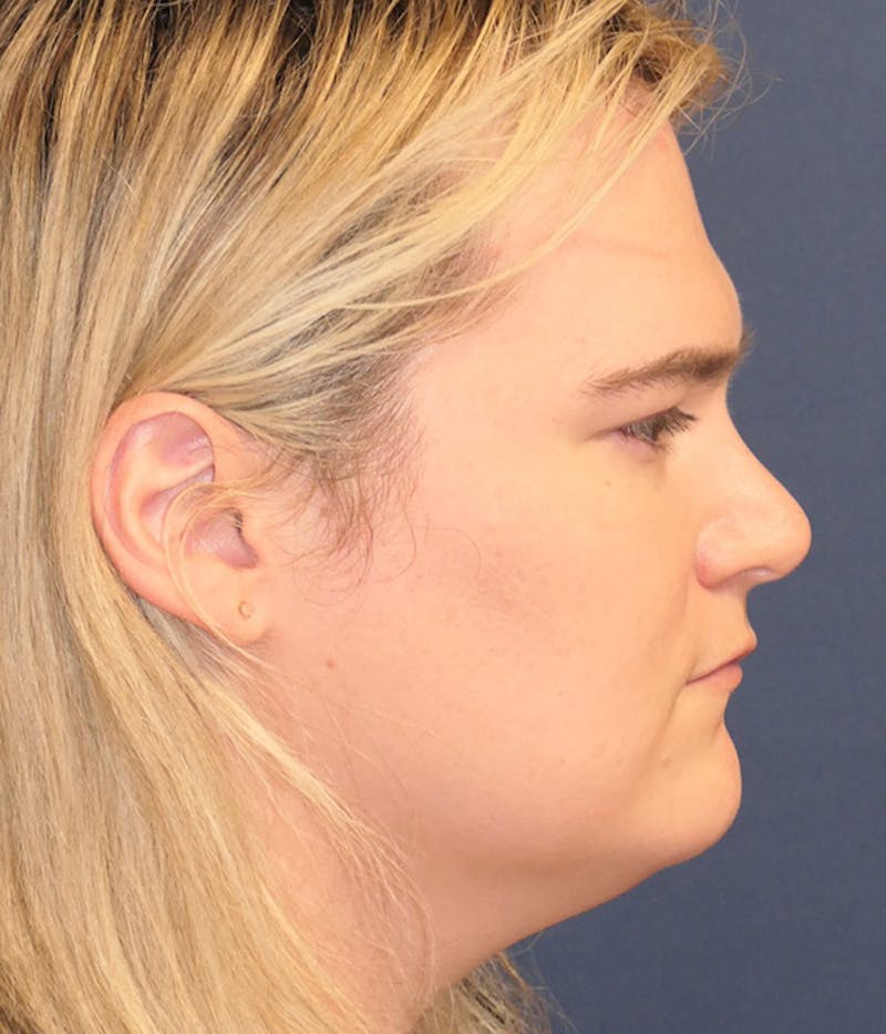 Feminizing Surgery Before & After Gallery - Patient 414617 - Image 5