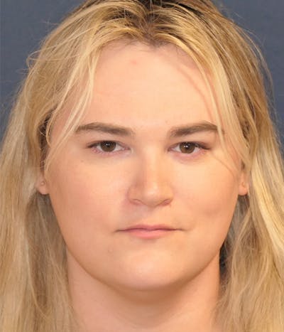Feminizing Surgery Before & After Gallery - Patient 414617 - Image 1