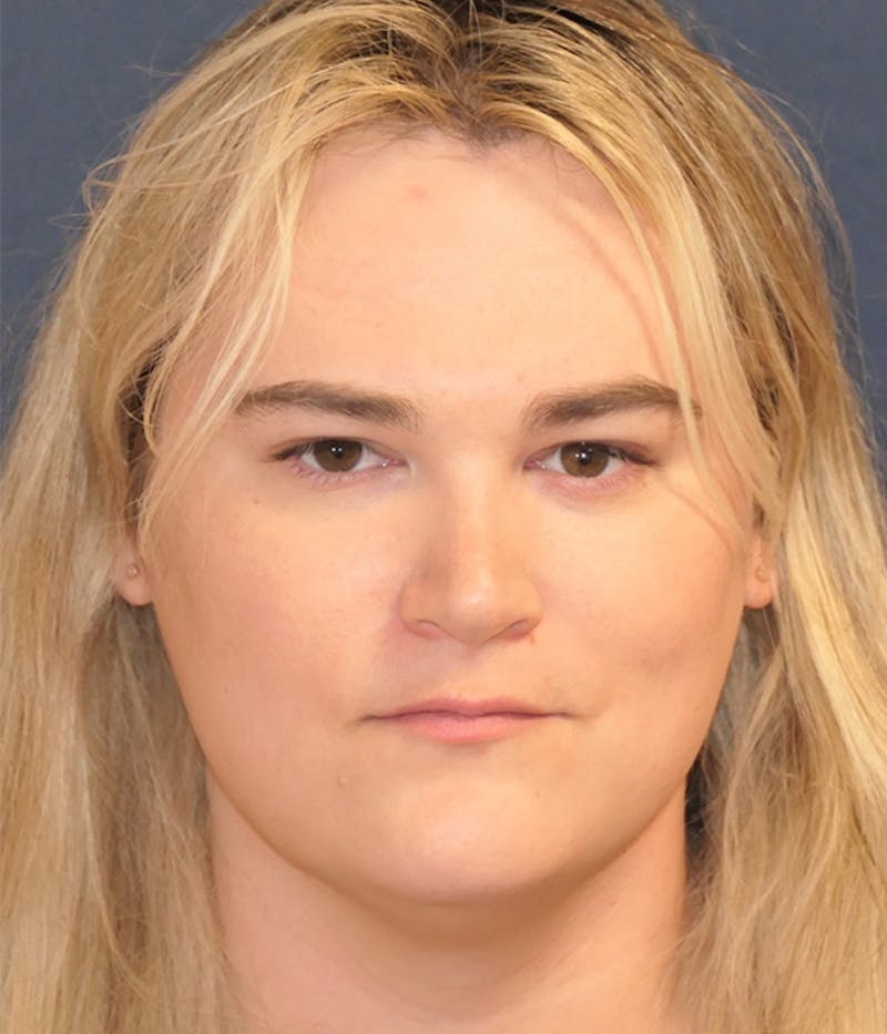 Feminizing Surgery Before & After Gallery - Patient 414617 - Image 1