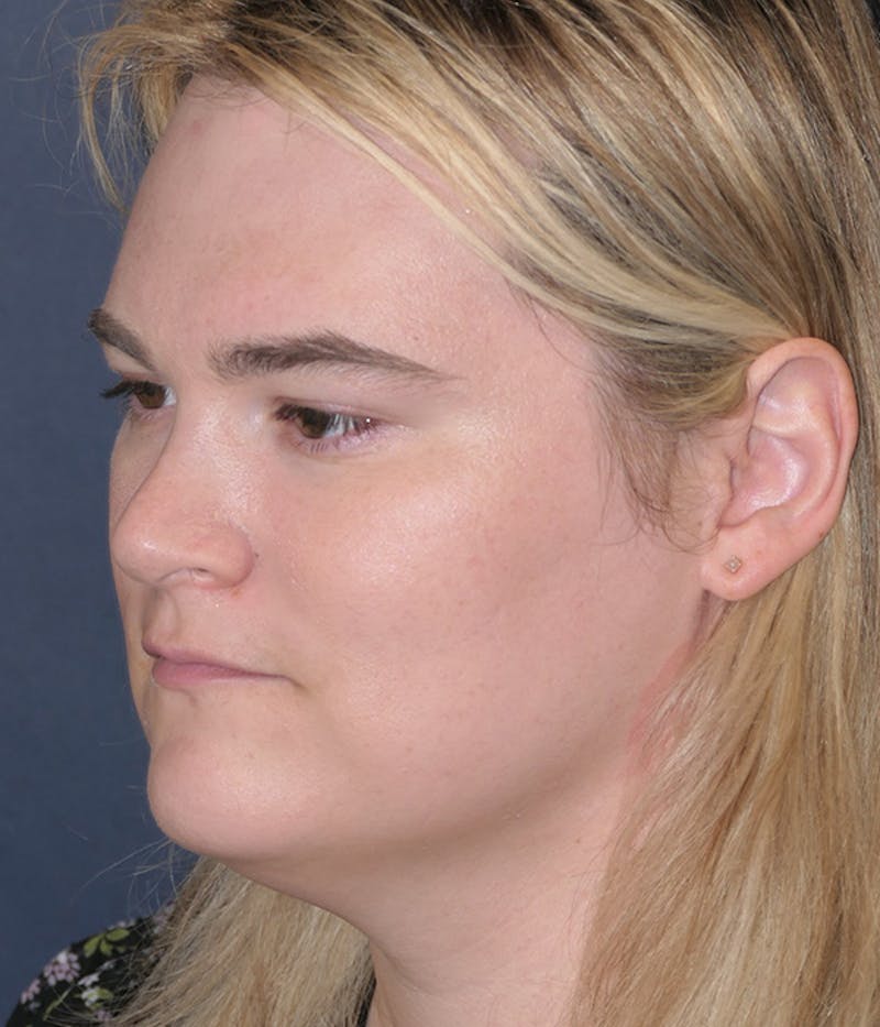 Feminizing Surgery Before & After Gallery - Patient 414617 - Image 7