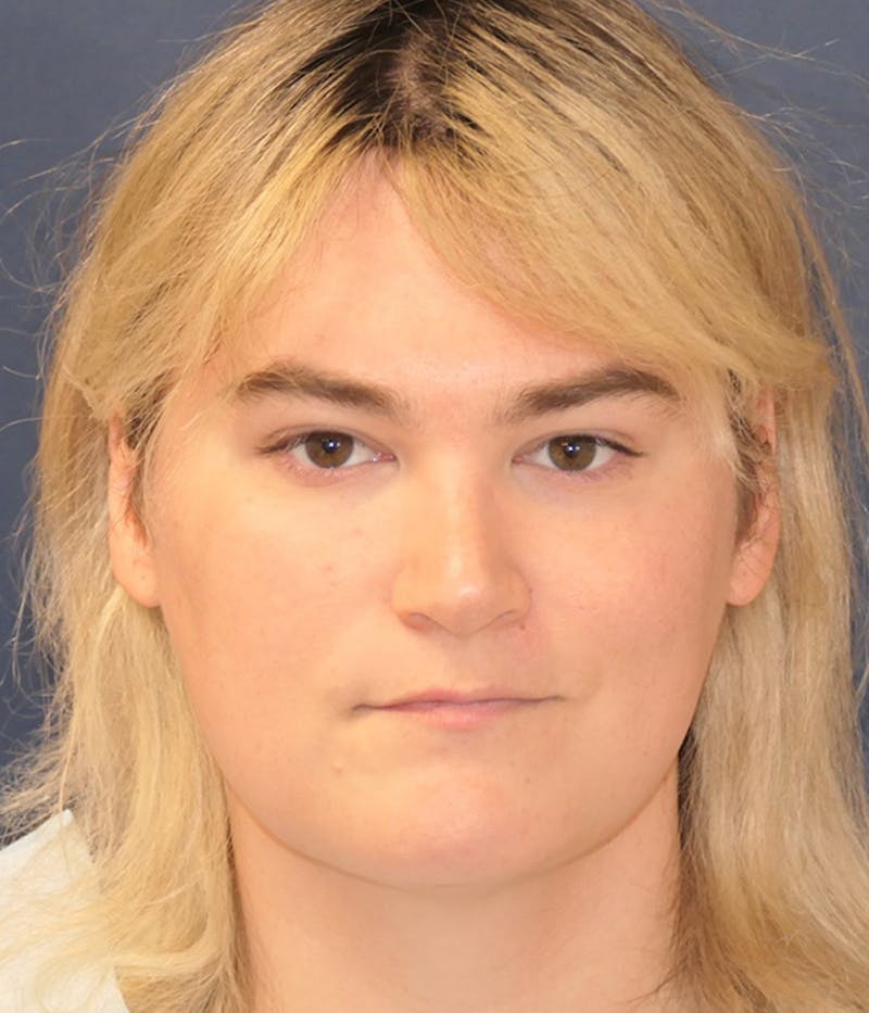 Feminizing Surgery Before & After Gallery - Patient 414617 - Image 2