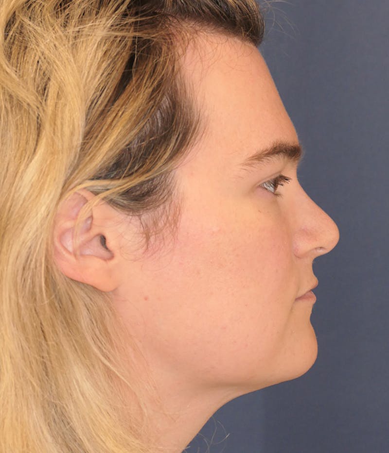 Feminizing Surgery Before & After Gallery - Patient 414617 - Image 6