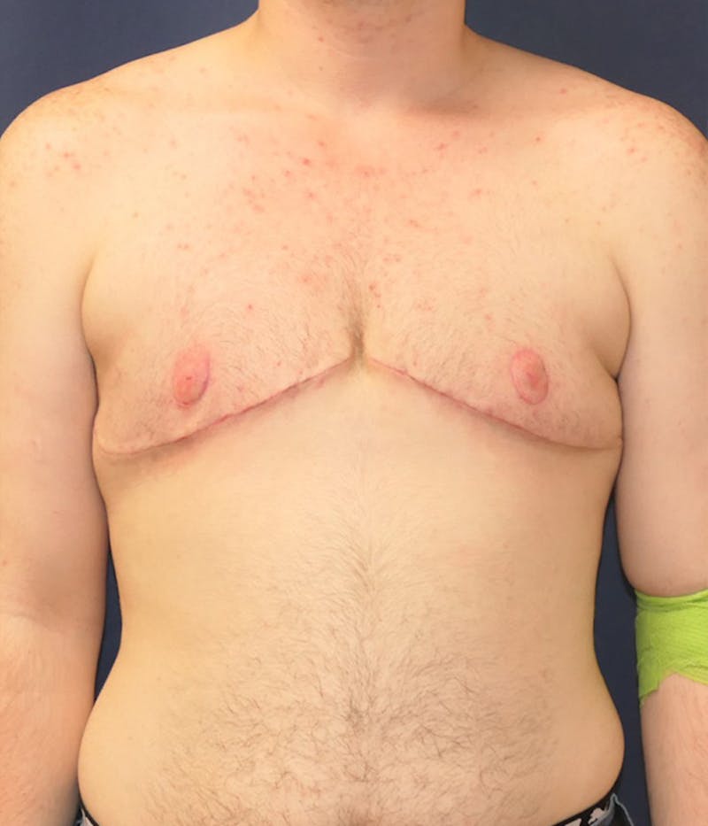 Masculinizing Surgery Before & After Gallery - Patient 174341 - Image 2