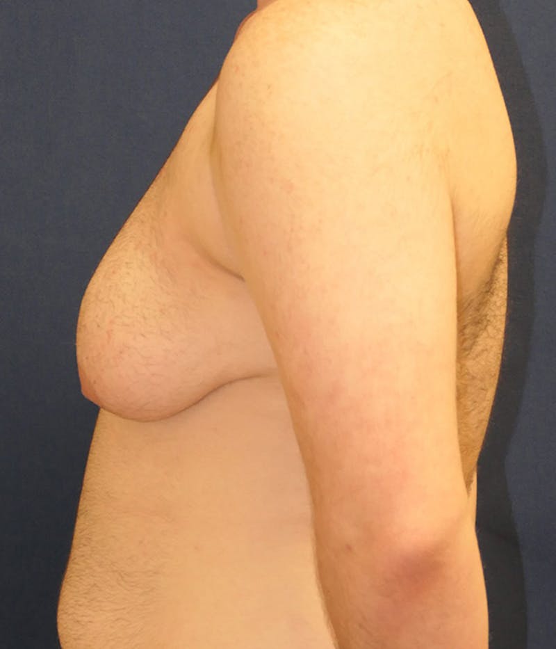 Masculinizing Surgery Before & After Gallery - Patient 174341 - Image 5