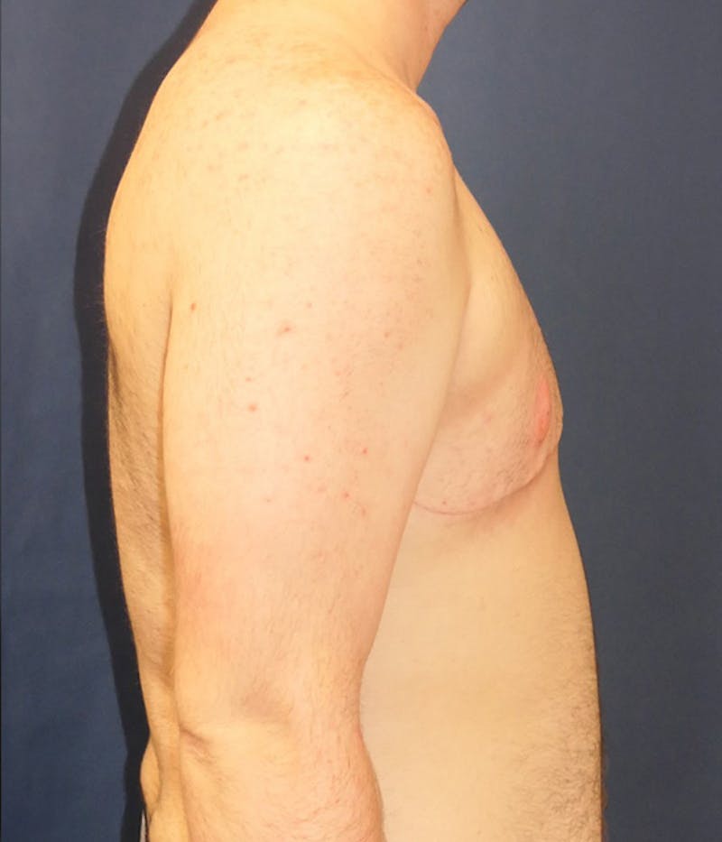 Masculinizing Surgery Before & After Gallery - Patient 174341 - Image 4