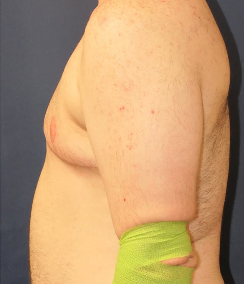 Masculinizing Surgery Before & After Gallery - Patient 174341 - Image 6